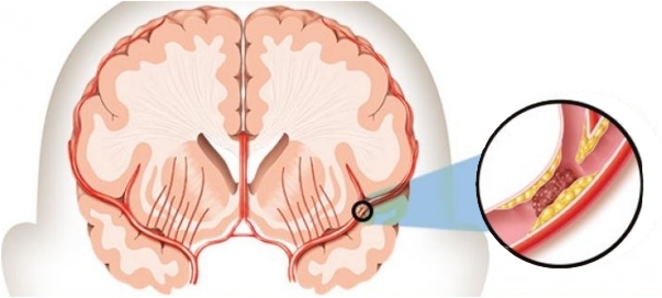 Что такое инсульт