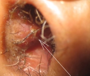 Фурункул в носу