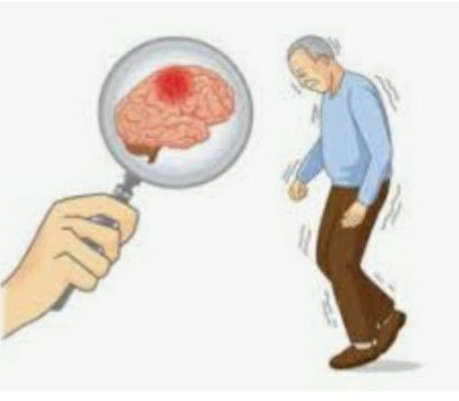 Болезнь Паркинсона. Не опускайте руки