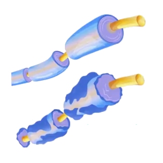 Рассеянный склероз