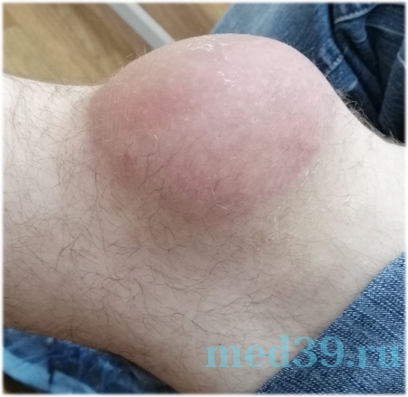 Бурсит колена фото