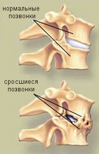 болезнь Бехтерева