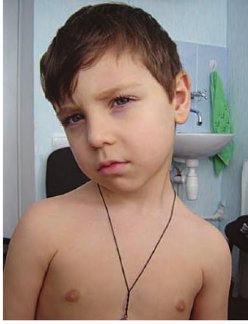 Болезнь Гризеля