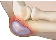 Бурсит локтя