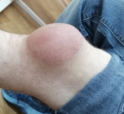 Препателлярный бурсит колена