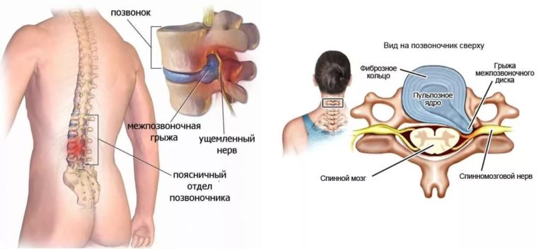 дорсопатия поясничного отдела