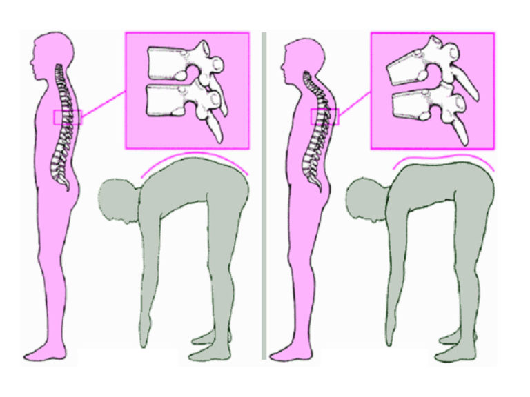 симптомы дорсопатии