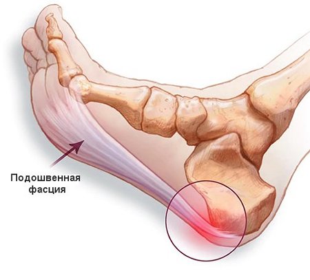 Пяточная шпора