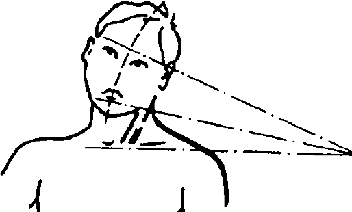 врожденная мышечная кривошея