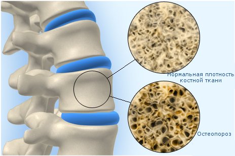 Остеопороз