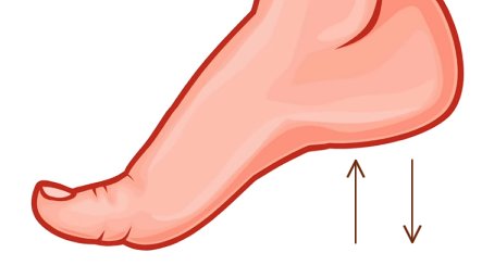 Бурсит большого пальца стопы