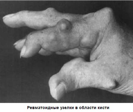 ревматоидный артрит