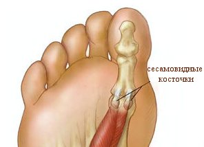 сесамовидные кости
