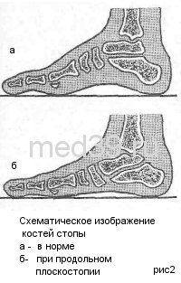 Плоскостопие упражнения