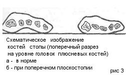 Плоскостопие