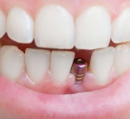 Почему отторгаются или не приживаются импланты?