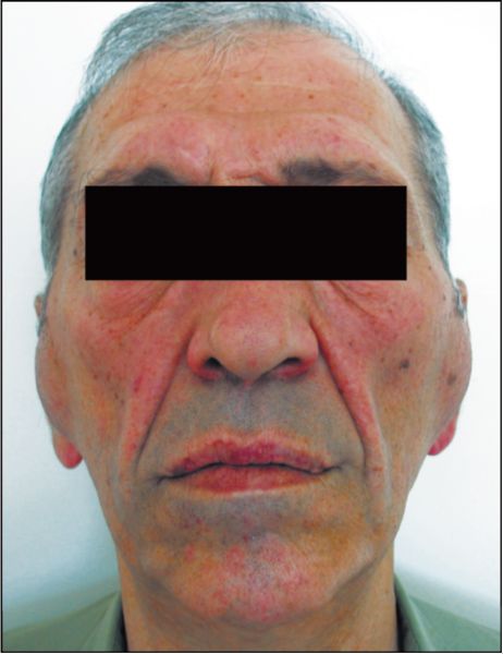 Болезнь Маделунга