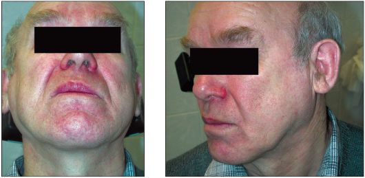 увеличение слюнных желез 