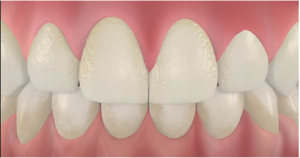 зубной налет