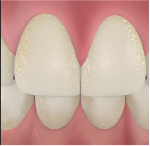 зубной налет