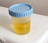 Цистит: сдаем анализы