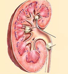 камни в почках