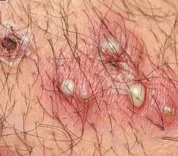 Паховый лимфогранулематоз