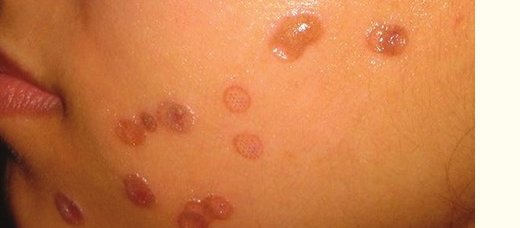 Осложнения пилинга