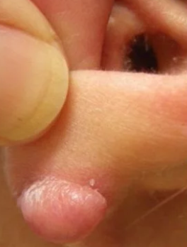 Осложнения после пирсинга - келоидные рубцы.