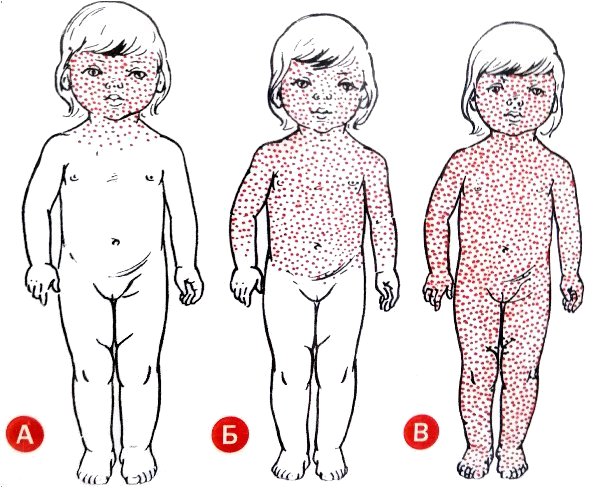 Корь, сыпь у ребёнка фото