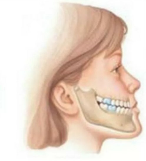 Неправильный прикус: надо ли исправлять?