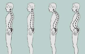 искривление позвоночника