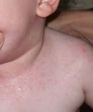 Потница у ребенка