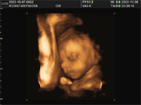 3d узи плода