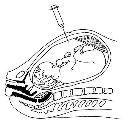 Амниоцентез