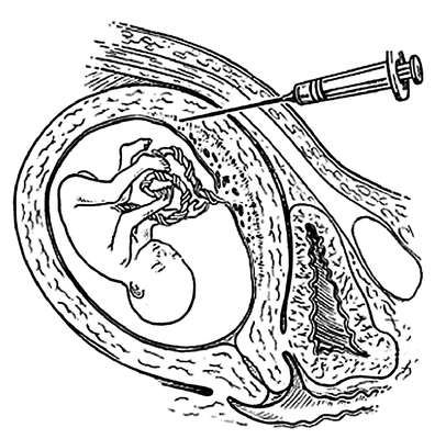 Биопсия хориона
