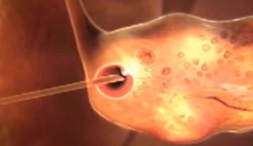 Экстракорпоральное оплодотворение, ЭКО