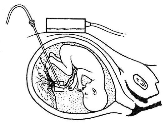 Кордоцентез