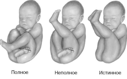 тазовое предлежание