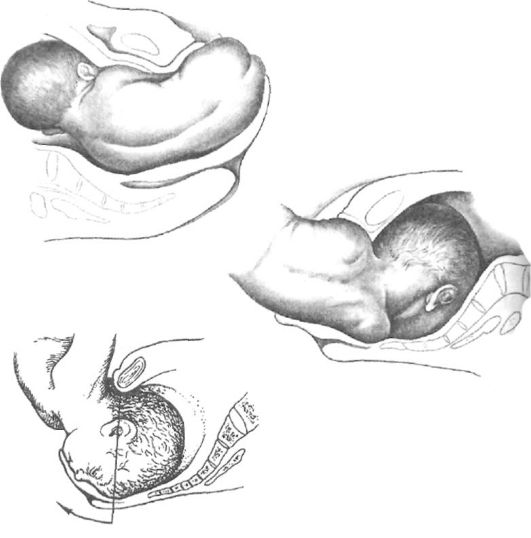 тазовое предлежание