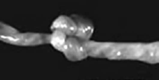 Узел пуповины