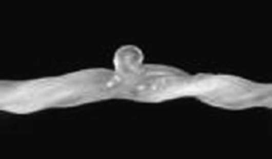 Узел пуповины ложный