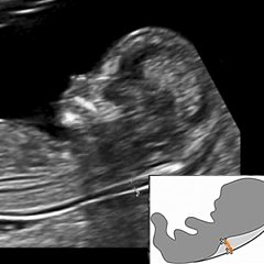 воротниковая зона плода