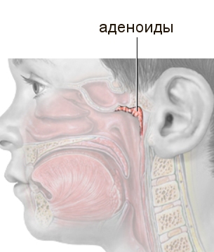 народные методы лечения аденоидов