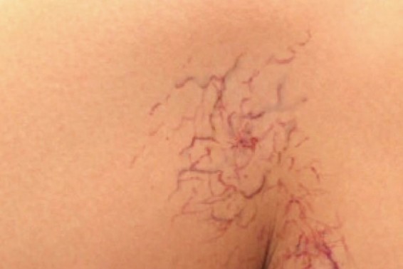 Лечение сосудистой веточки народными средствами