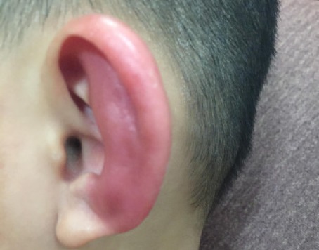 Покраснение ушной раковины при перихондрите