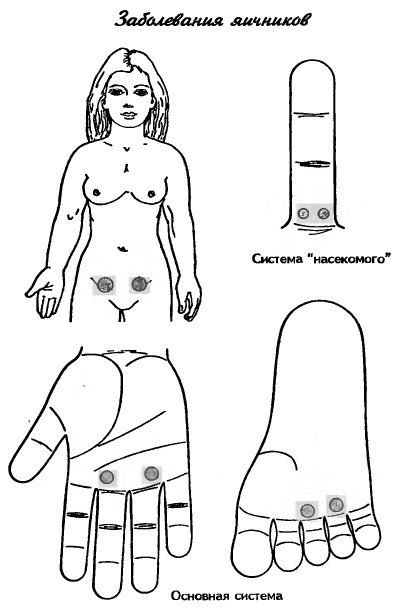 су-джок заболевания яичников