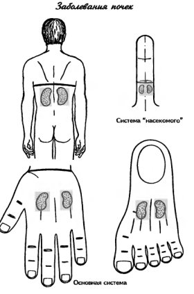 заболевания почек
