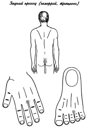 су-джок геморрой